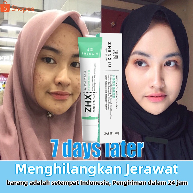 Obat Jerawat Penghilang Bekas Jerawat Bpom Acne Cream Skin Care Salep Jerawat Dan Bekas Jerawat Paling Ampuh