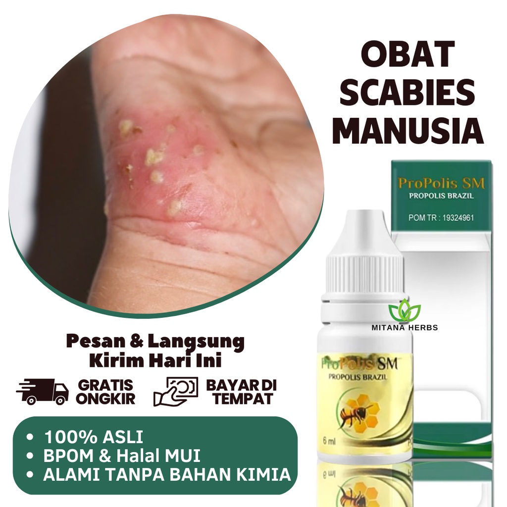 Obat Scabies Manusia, Obat Luka Bernanah Dan Bengkak, Obat Luka Bernanah Dan Berair, Obat Luka Berna