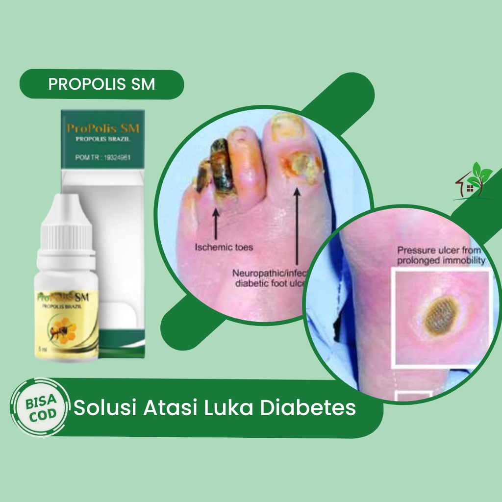 Obat Luka Diabetes, Obat Luka Diabetes Kering, Obat Luka Diabetes Basah, Obat Luka Diabetes Bernanah