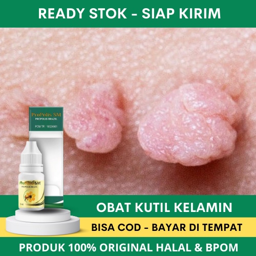 Obat Kutil Kelamin, Kutil Kelamin Laki Laki, Kutil Kelamin Wanita, Bintik Putih di Kelamin, Salep Ku