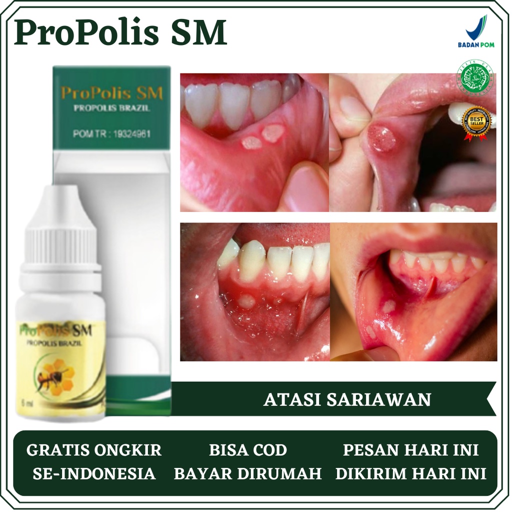 Obat Sariawan, Obat Sariawan Parah, Obat Sariawan Berdarah, Obat Sariawan Menahun, Obat Sariawan Mer