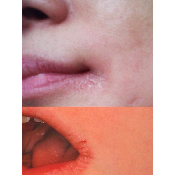 Anti Iritasi Series Aknèlab (1 paket) menyembuhkan iritasi pada kulit wajah