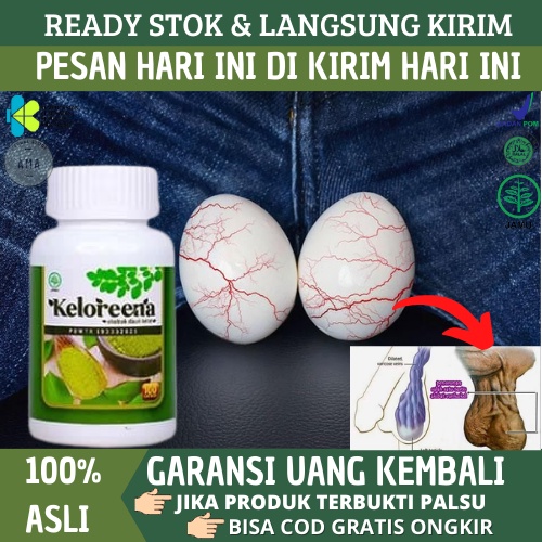 Obat Varikokel Bengkak, Obat Pembuluh Darah Vena Bengkak, Obat Varises Testis, Obat Urat Menonjol Di