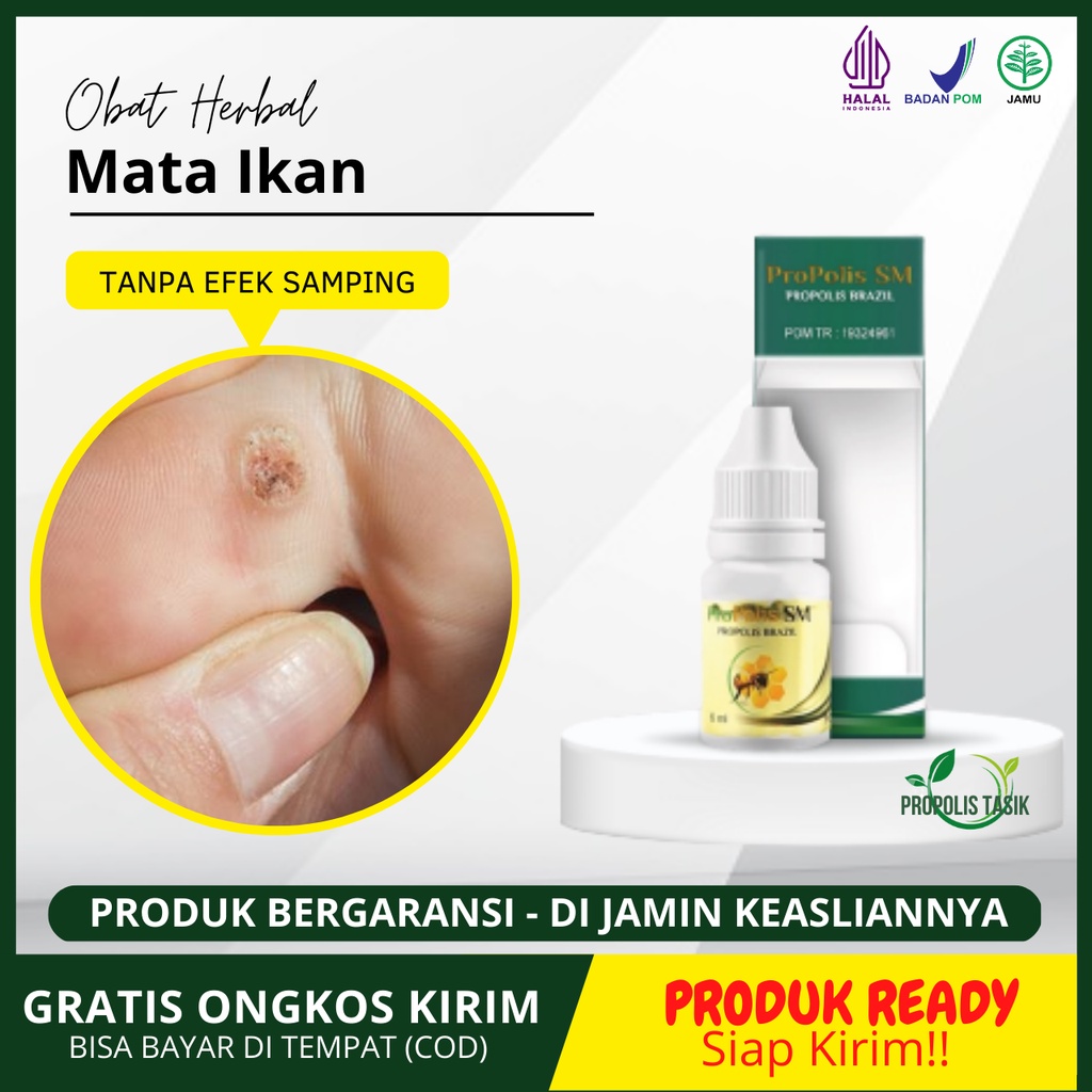 Obat Mata Ikan Telapak Kaki / Mata Ikan Telapak Tangan, Clavus, Salep Mata Ikan Jari Tangan Dan Kaki