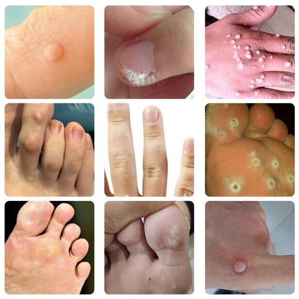 Obat Mata Ikan Penghilang Tahi Lalat Wart Removal 20g Repair And Clean Skin Tag Remover Di Wajah Menghilangkan pada mata/ wajah/ leher/ bagian tubuh/ Kapalan Di Tangan Dan Kaki Krim Antibakteri Krim Penghilang Kutil