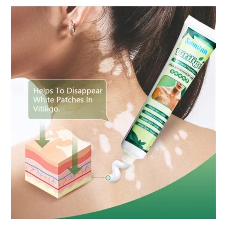 Salep Cream Vitiligo 20 gram Herbal Aman, Salep Cream Belang Herbal Aman, Salep Cream Bercak Herbal Aman
