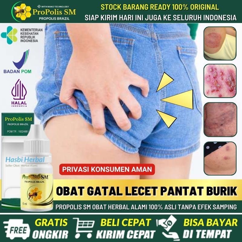 Obat Bintik - Bintik Berair di Pantat, Obat Pantat Gatal, Salep Alami Gatal Kulit Pantat, Obat Jeraw