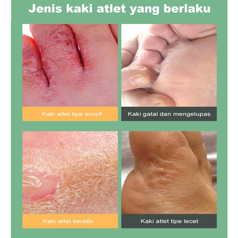 Obat Gatal Kaki,Obat Gatal di Sela Jari Kaki dan Tangan,Obat Oles Kulit Gatal,Obat Kutu Air Kurap Kudis Infeksi Jamur,Salep Gatal bernanah 20ml