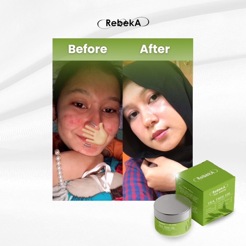 GEL MASK TEA TREE OIL FOR ACNE SKIN | SLEEPING MASK | REBEKA | BPOM | 30gr | JERAWAT