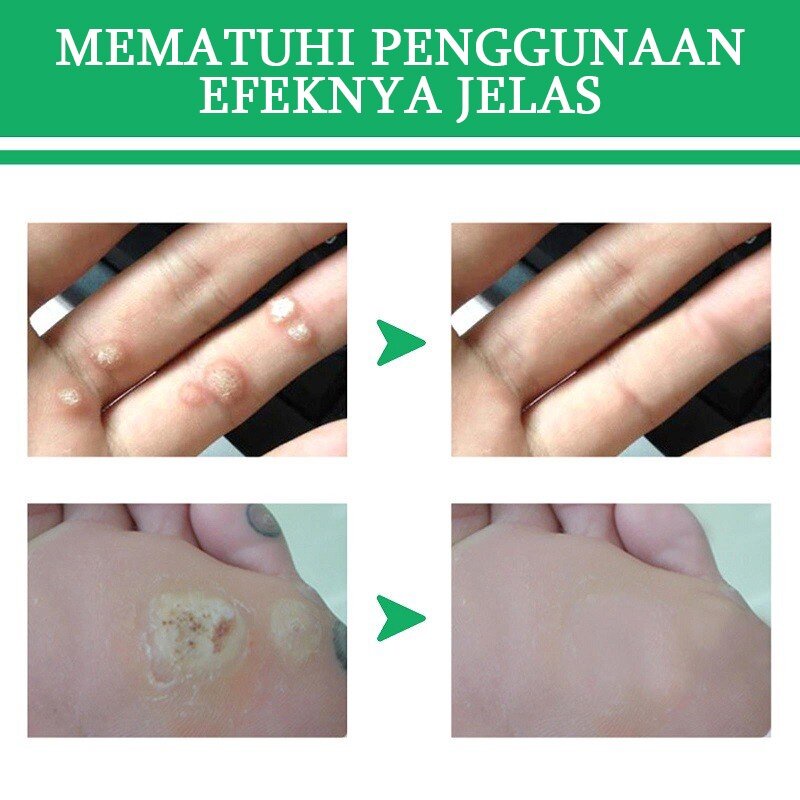 Obat Mata Ikan Penghilang Tahi Lalat Wart Removal 20g Repair And Clean Skin Tag Remover Di Wajah Menghilangkan pada mata/ wajah/ leher/ bagian tubuh/ Kapalan Di Tangan Dan Kaki Krim Antibakteri Krim Penghilang Kutil