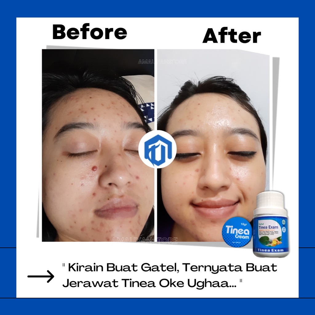 Tinea Exam Original Obat Kapsul Gatal-Gatal Ampuh Salep Krim Gatal Kulit Kadas Panu Eksim Menahun Di Kaki Selangkangan Pria Dan Wanita Paling Ampuh Permanen