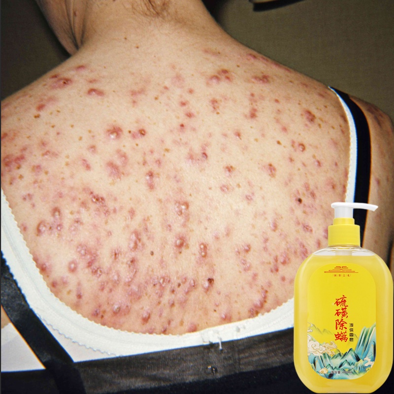 Jual sabun penghilang jerawat punggung sabun jerawat punggun acne body