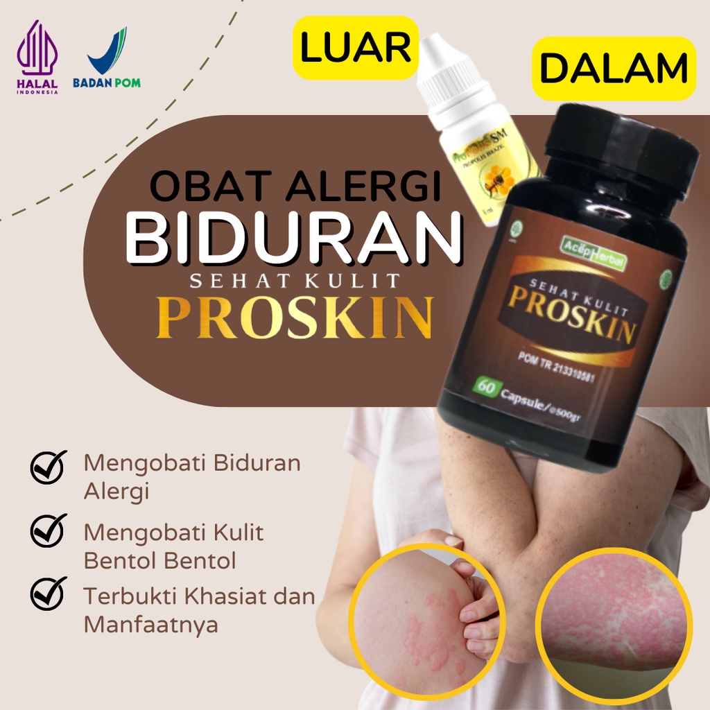 Obat Biduren Alergi Dingin dan Makanan Biduran Herbal Menahun Kulit Gatal Kaligata Bentol Kemerahan 