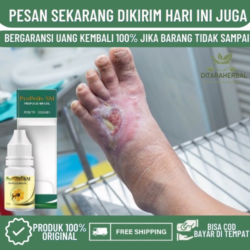 Obat Oles Luka Diabetes, Obat Luka Diabetes Bernanah, Obat Luka Diabetes Basah, Obat Luka Diabetes K