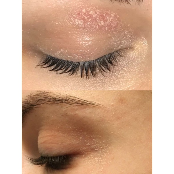 Anti Iritasi Series Aknèlab (1 paket) menyembuhkan iritasi pada kulit wajah