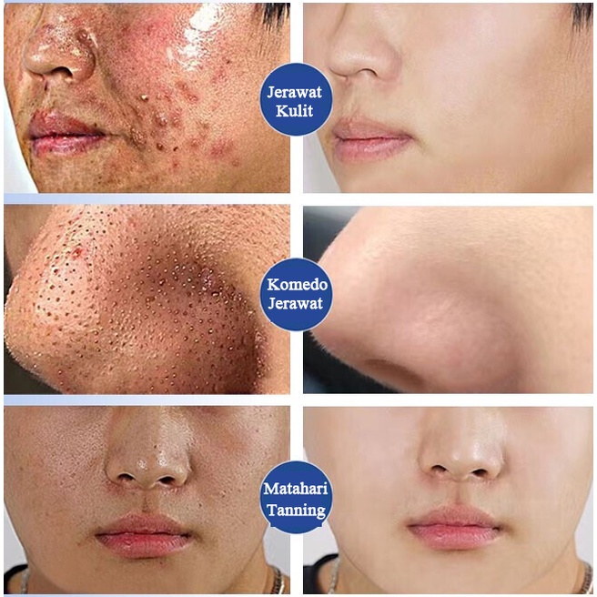 Face Wash For Men Acnes Cuci Muka Pria komedo Pembersih muka acnes 150g Anti-Acne  Membersihkan pori Kontrol minyak