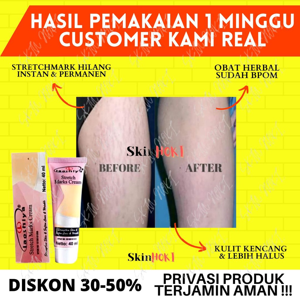 CREAM STRECHMARK AMPUH PENGHILANG SELULIT LAOSHIYA STRETCH MARKS CREAM 40ML PENGHILANG BEKAS LUKA ORIGINAL BPOM