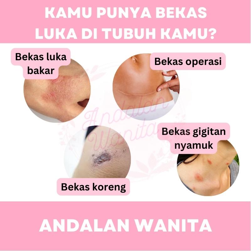 Obat Cream Krim Salep Penghilang Mengobati Luka Kulit Lama Cacar Bekas Jerawat Flek Hitam Keloid Luka Bakar Gatal Knalpot Strech Mark Caesar Mengecilkan Pori Pori Permanen Meilibahenling Melibahenling Meilibaheling Bio Herbal Original 100% BPOM