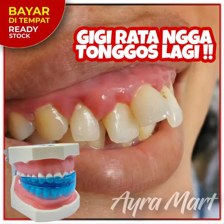 SOLUSI GIGI TONGGOS UNTUK KAMU  Alat perata gigi tonggos atas Alat gigi biar ga tonggos Alat pelurus