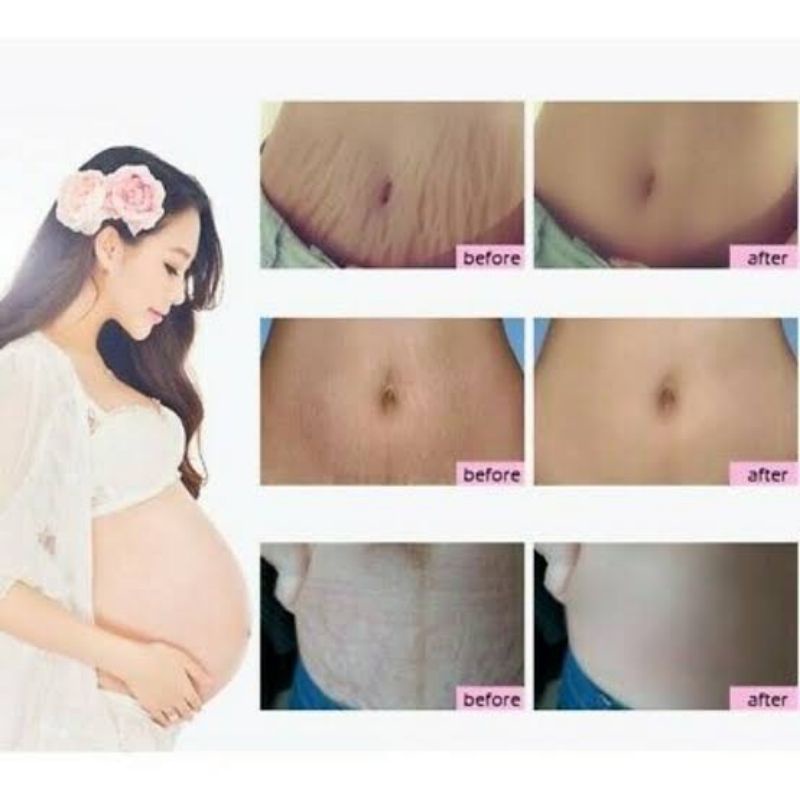 ISME Centella Stretch Mark Repair Cream Penghilang StretchMark Original