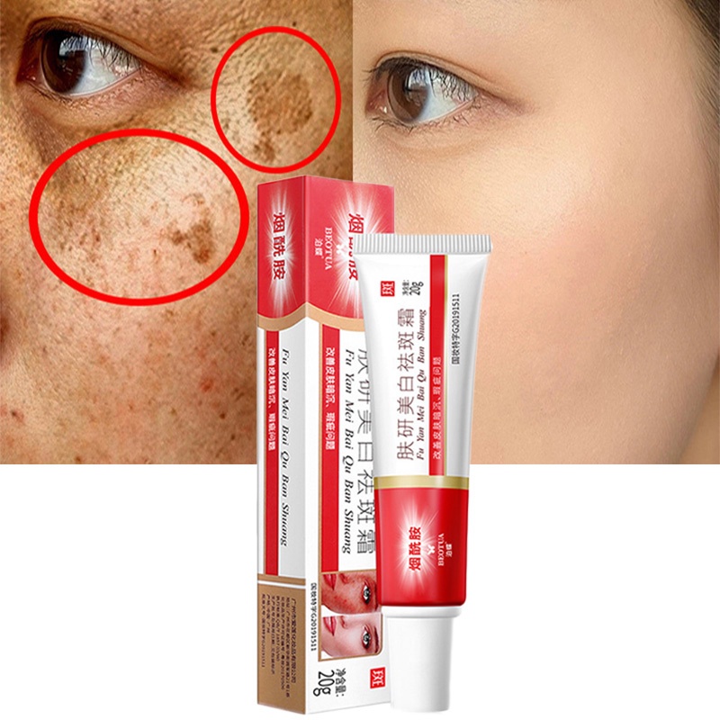 Whitening Freckle Cream Remove Dark Spots Anti Freckle Cream Niacinamide Fade Pigmentation Melasma Brighten Creams concealer