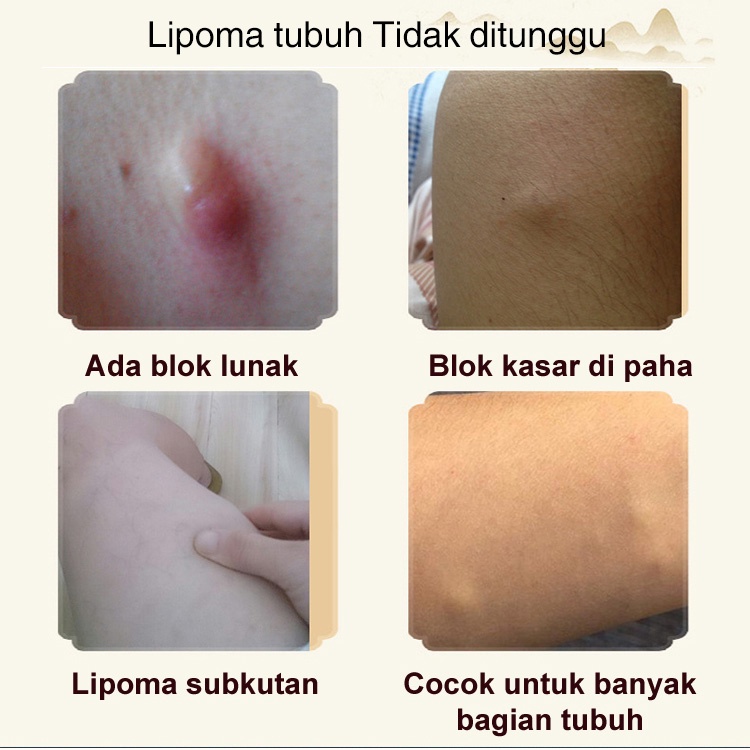 【COD】Krim Antitumor 30g Obat benjolan salep benjolan Obat Benjolan lipoma