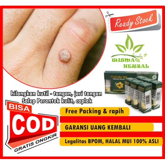 PROPOLIS SM hilangkan kutil - tangan, jari tangan, Salep Perontok kulit, caplak, Menghilangkan kutil