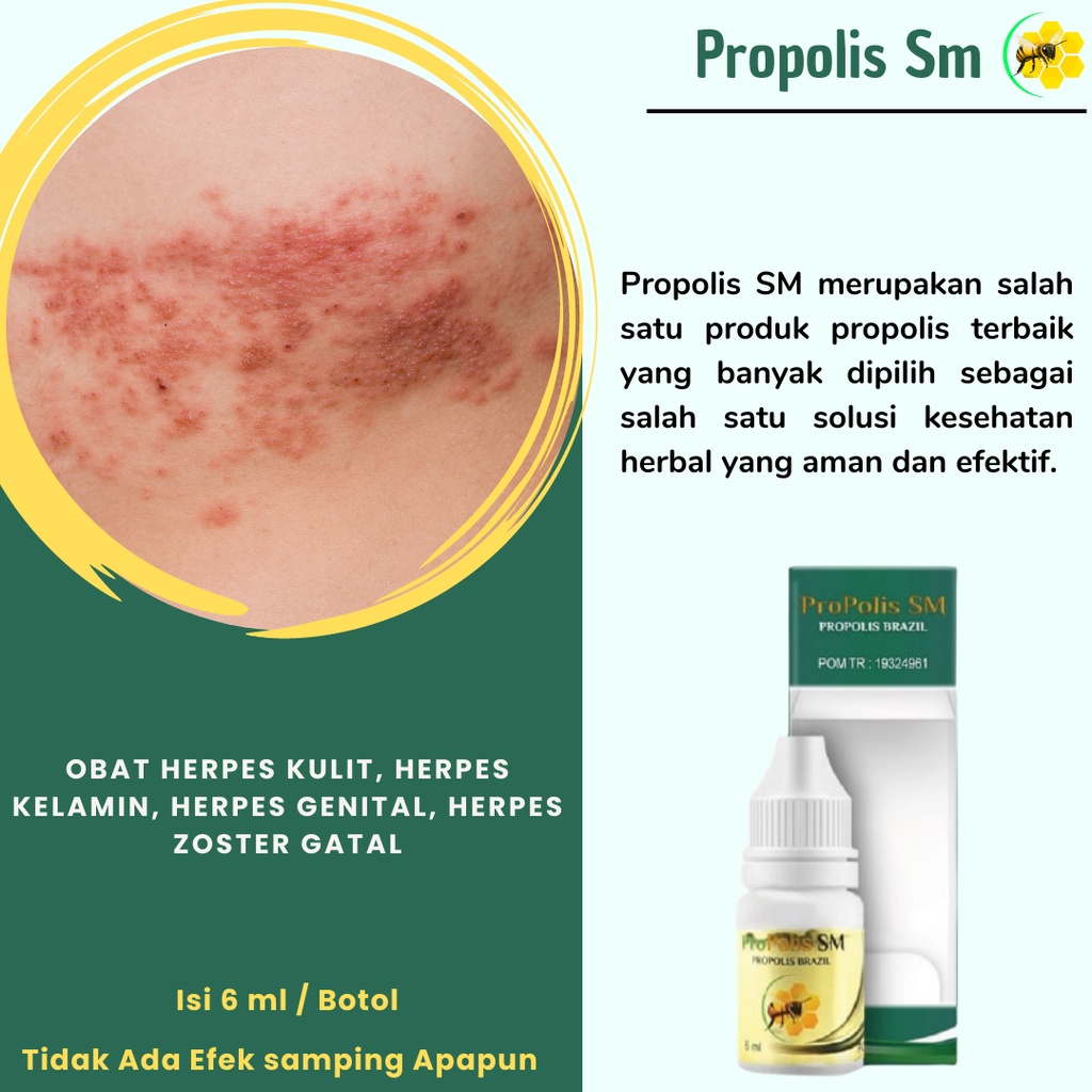 jual-propolis-sm-obat-herpes-kulit-obat-herpes-zoster-obat-herpes