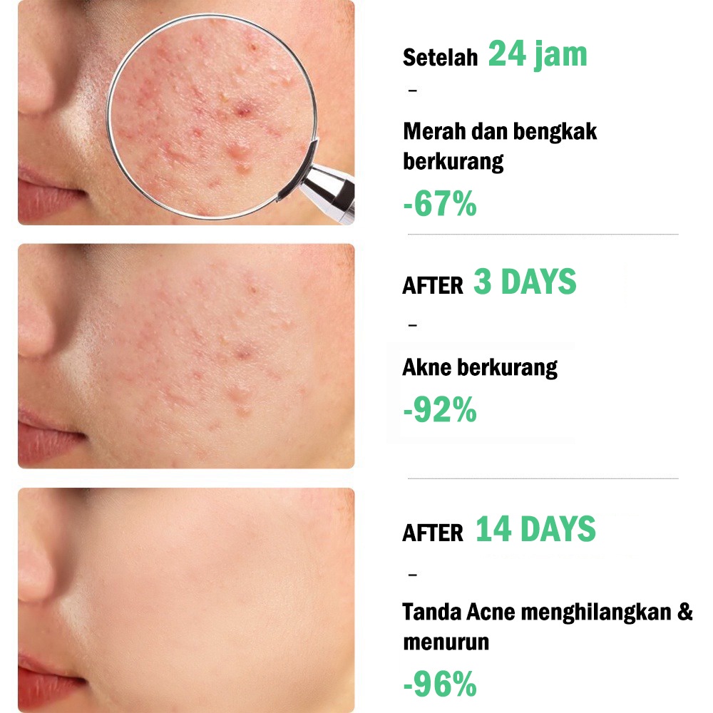 Obat Jerawat Penghilang Bekas Jerawat Bpom Acne Cream Skin Care Salep Jerawat Dan Bekas Jerawat Paling Ampuh