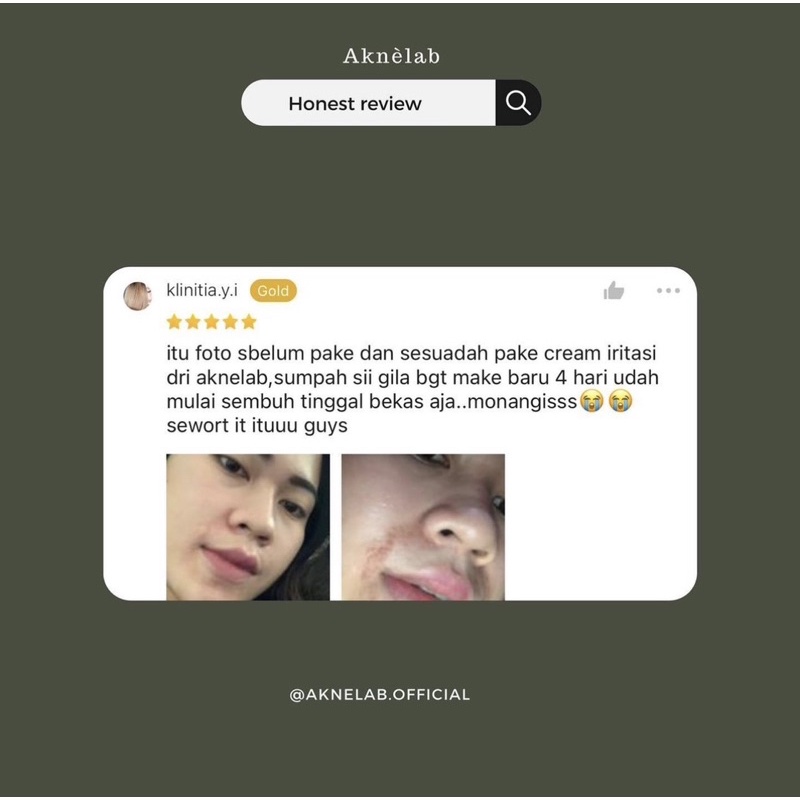 Anti Iritasi Series Aknèlab (1 paket) menyembuhkan iritasi pada kulit wajah