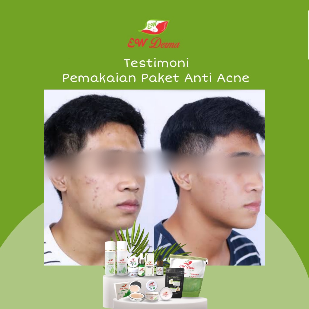 Obat Jerawat Pria Bopeng Bekas Jerawat Komedo Flek Hitam Cream Pemutih Cowok BPOM