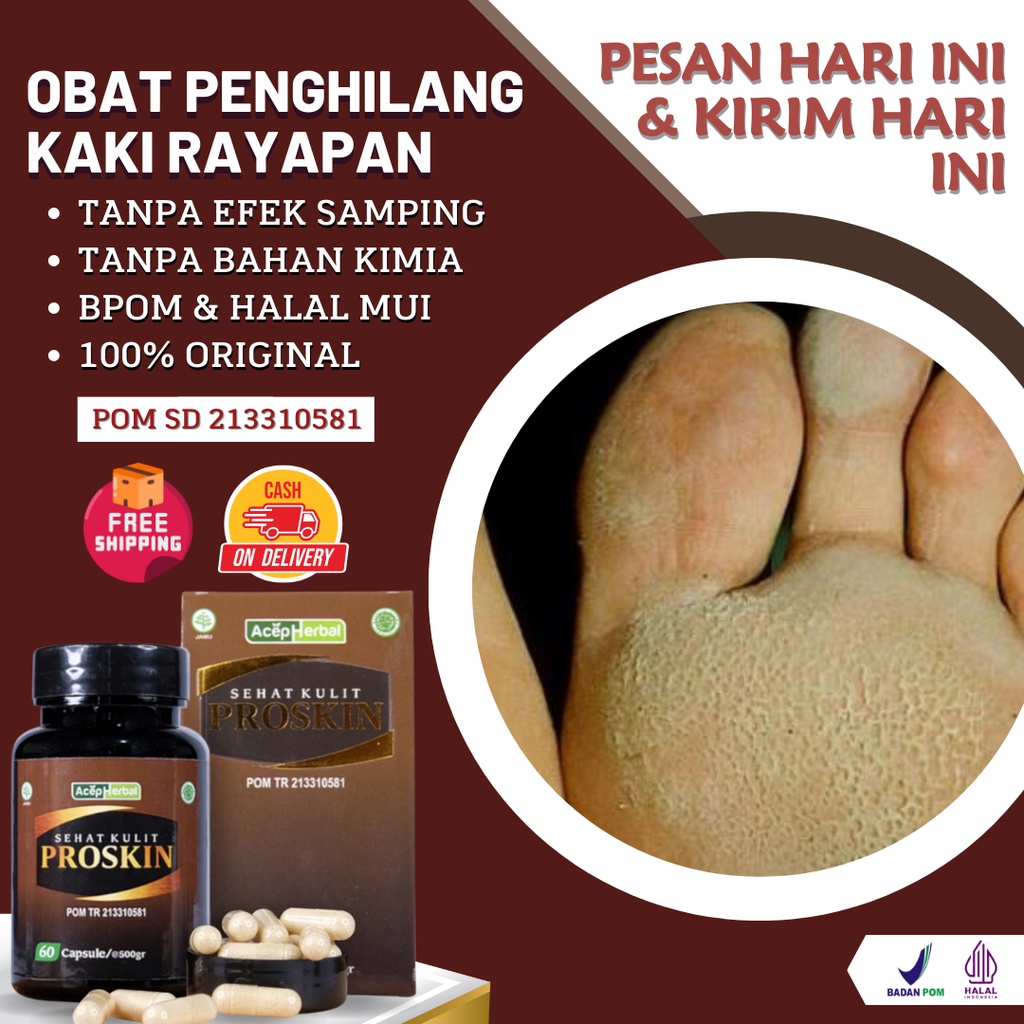 Mitana Herbal - Obat Kaki Rayapan Berlubang / Obat Kaki Rayapan Dan Bau / Obat Telapak Kaki Bolong /