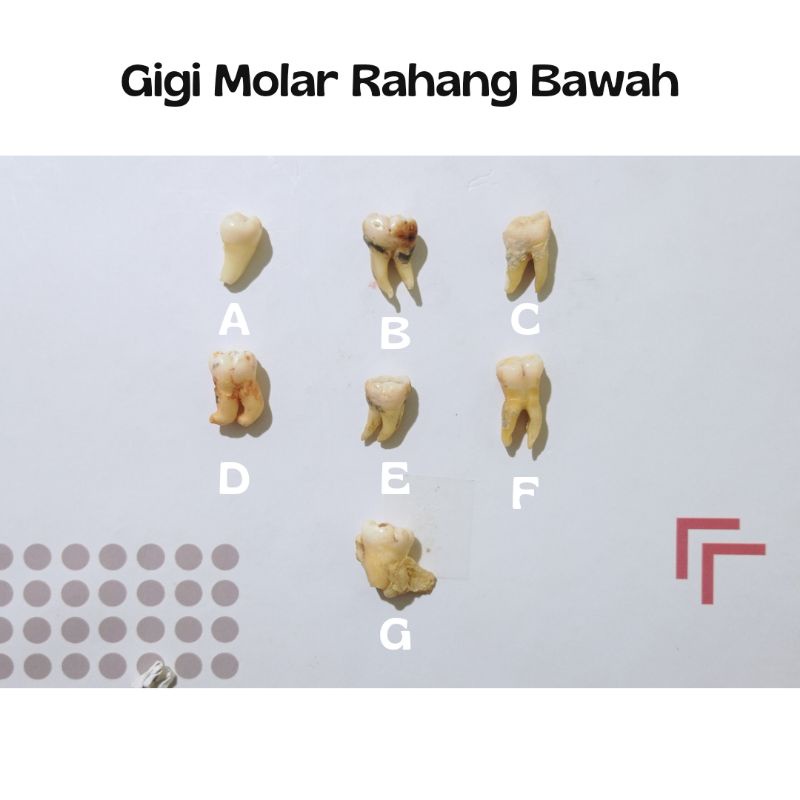 Gigi Molar Rahang Bawah 1 2 3 Gigi Permanen Asli | Gigi kelainan Ankilosis | Gigi  kelainan Dilasera