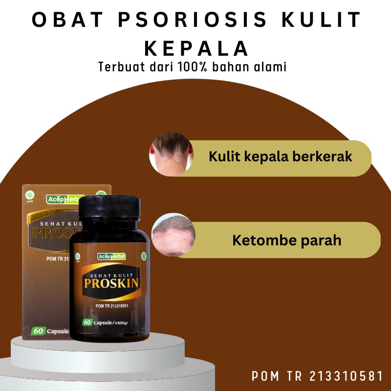 Jual Kaka Herbal Obat Ketombe BerKerak Di Kulit Kepala, Obat Ketombe