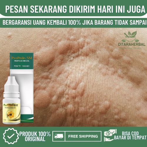 Obat Badan Gatal Gatal, Obat Kulit Gatal, Obat Gatal Menahun, Obat Gatal Bentol Bentol, Obat Gatal K