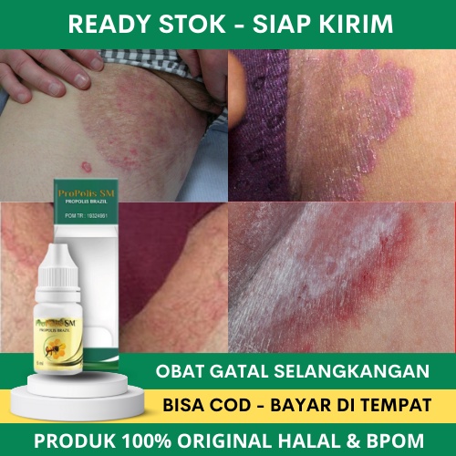 Obat Selangkangan Hitam, Obat Selangkangan Hitam dan Berjamur, Obat Selangkangan Hitam dan Gatal, Ob