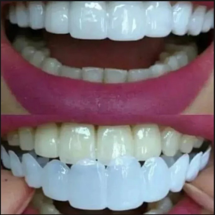 SIAP COD Snap on smile veneer original satu set atas bawah gigi palsu tiruan