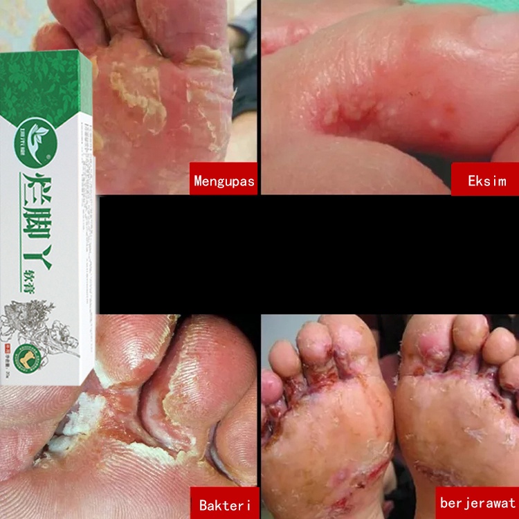 Obat Telapak Kaki Rayapan Kaki Rayapan Kaki Rayap Bau 20g Kaki Bolong Bolong Seperti Kena RayapTumit Kaki Pecah Telapak Kaki Rayapan Penghilang Kaki Rayapan Kaki Bolong Bolong Kaki Bolong Telapak Kaki Bolong, Telapak Kaki Bolong Bolong