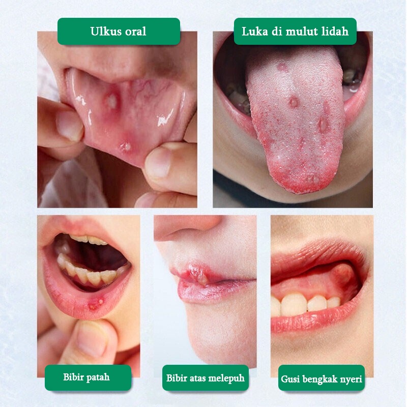 Obat sariawan mulut Perawatan mulut lainnya Spray obat mulut/ Mouth spray Obat sakit mulut 30ml Semprotan Larutan Antibakteri Bernanah Luka Di Mulut Dan Lidah Pembengkakan Nyeri Gusi Obat sariawan paling mujarab