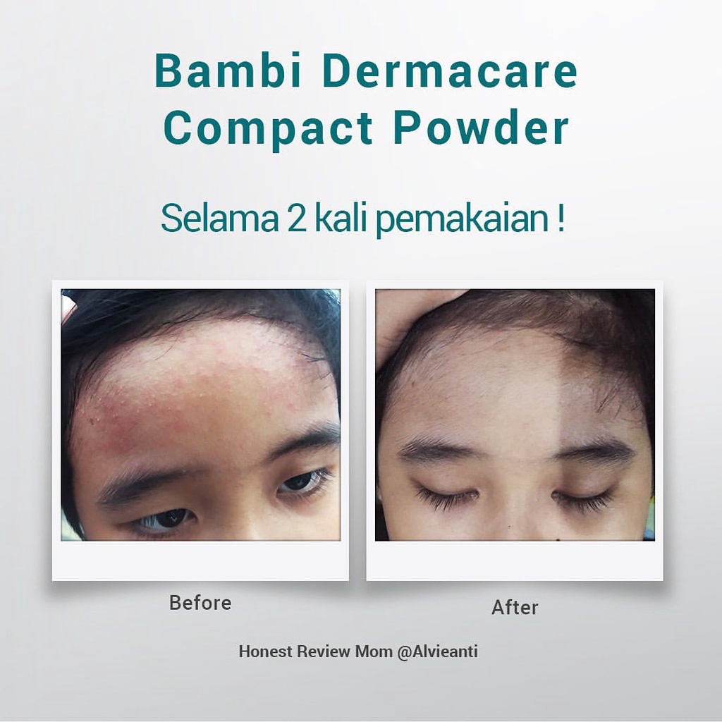 Bambi Baby Compact Powder Dermacare 40gr | Bedak Padat Bayi Anak Khusus kulit Atopic / Eczema / Eksim / Triple Ceramide Powder