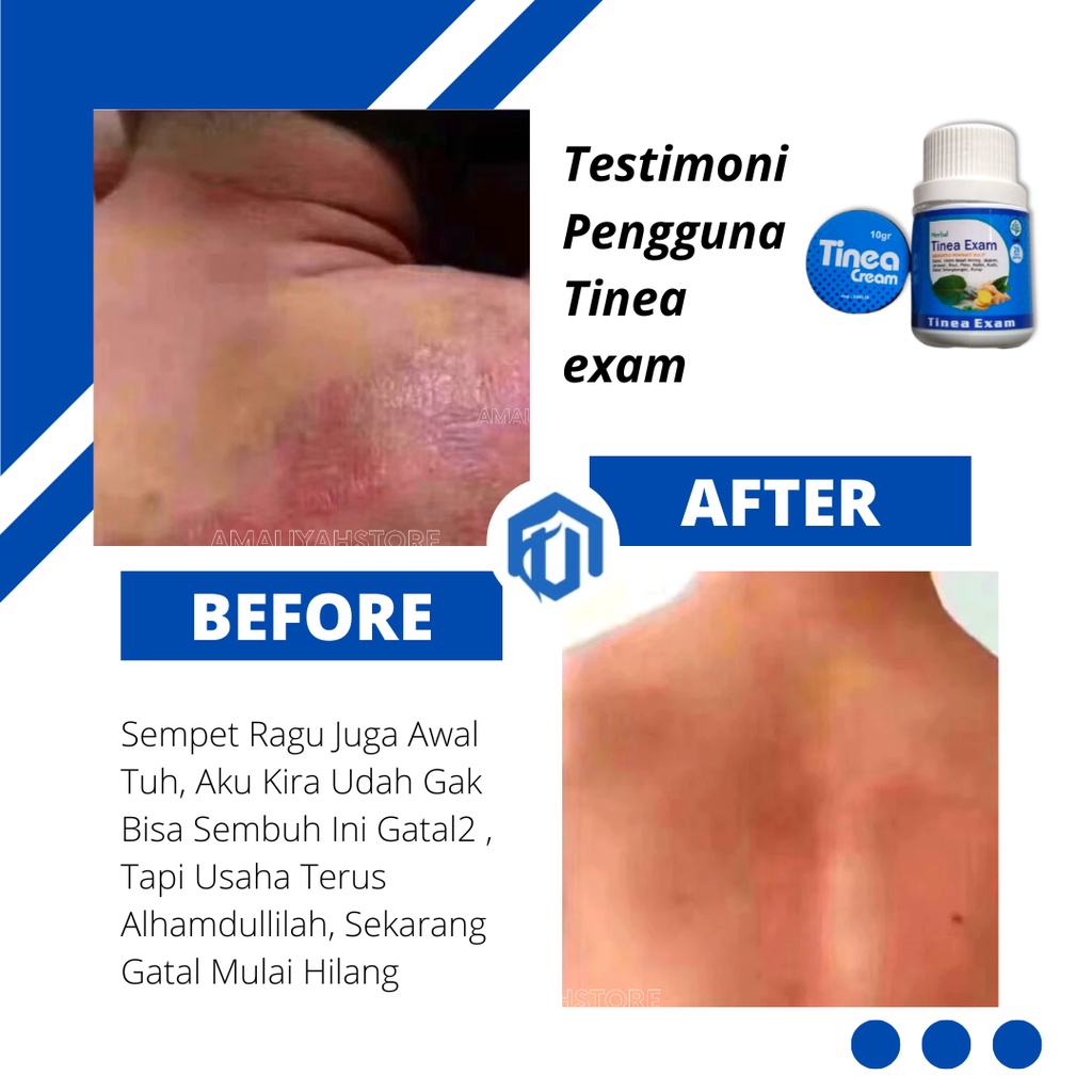 Tinea Exam Original Obat Kapsul Gatal-Gatal Ampuh Salep Krim Gatal Kulit Kadas Panu Eksim Menahun Di Kaki Selangkangan Pria Dan Wanita Paling Ampuh Permanen