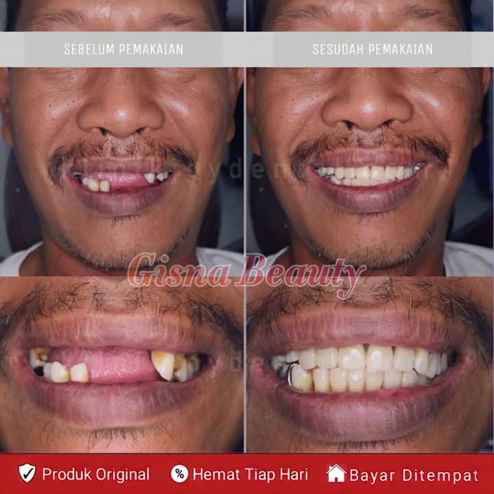 PALING KUAT  Penambal gigi ompong murah Gigi palsu penambal ompong Penambal gigi ompong permanen original penambal gigi ompong depan Penambal gigi original Gigi palsu penutup ompong depan belakang Gigi palsu Temptooth Temporary Tooth Asli 100% Original