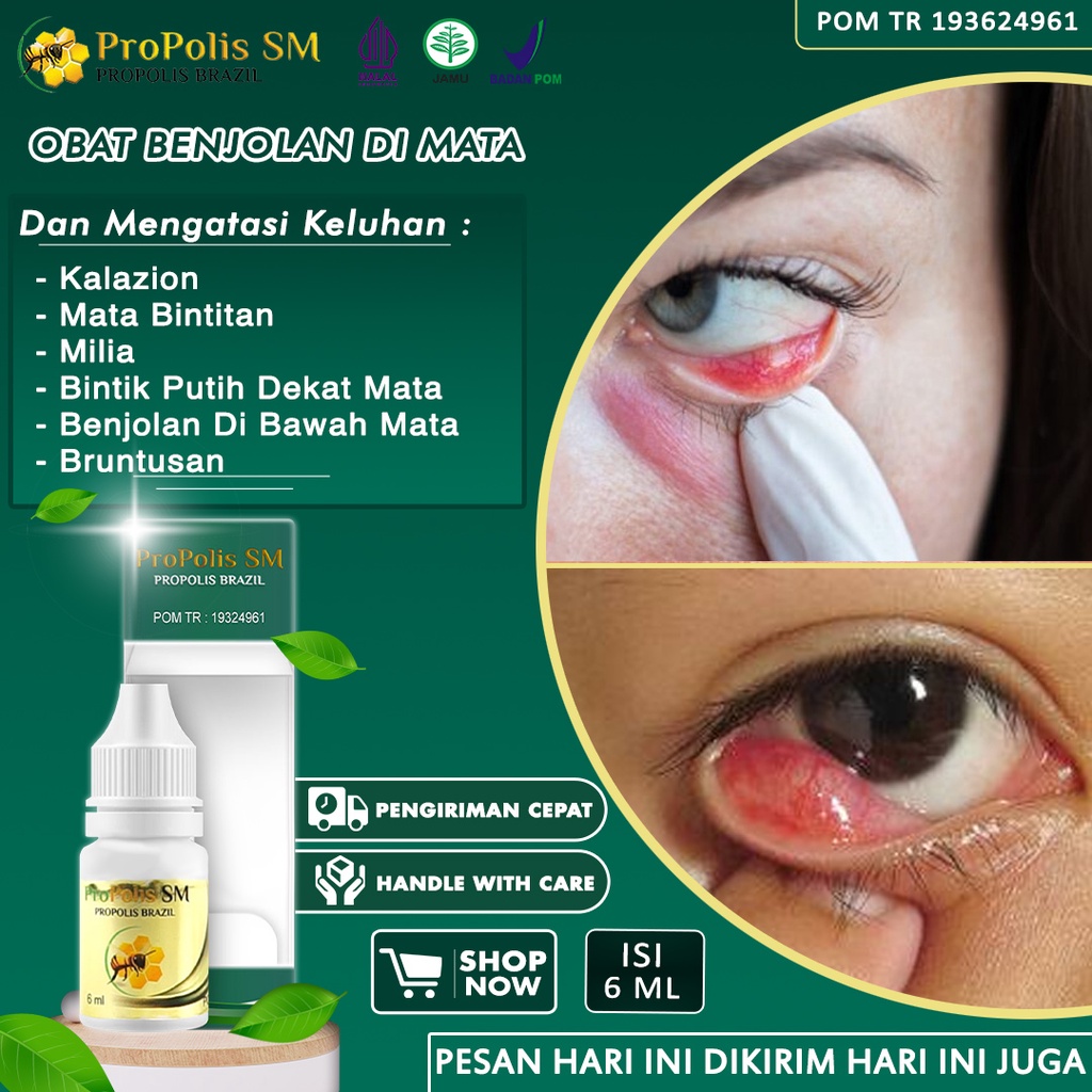 Jual Obat Benjolan Di Mata Kalazion Salep Mata Bintitan Di Dalam Penghilang Benjolan Di Kelopak