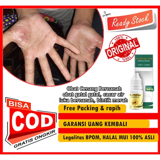 PROPOLIS SM - Obat Cenang Bernanah, obat gatal gatal, cacar air, luka bernanah, bintik merah, mengel