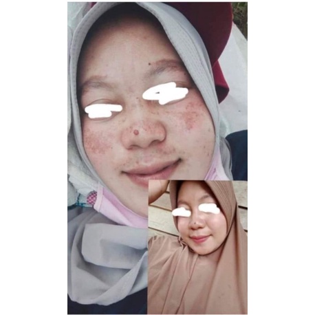 SALEP FLEK PRM LUXURY ORI BPOM DAPAT MEMUDARKAN FLEK MEMBANDEL SKINCARE LUXURY AGEN RESMI NTB