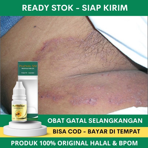 Obat Selangkangan Hitam, Obat Hitam Di Selangkangan, Menghilangkan Hitam Di Selangkangan, Obat Gatal