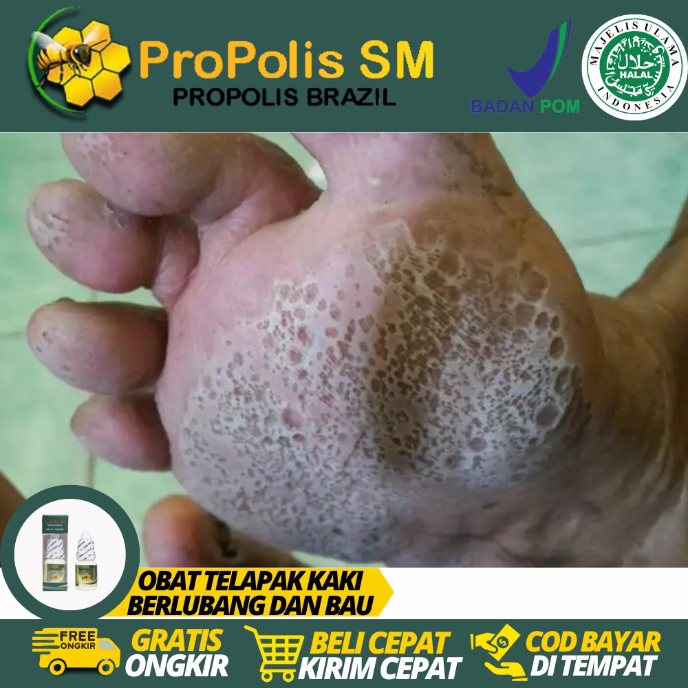 Obat Pitted Keratolisis, Obat Telapak Kaki Berlubang Kecil-Kecil, Telapak Kaki Bolong Bolong, Obat A