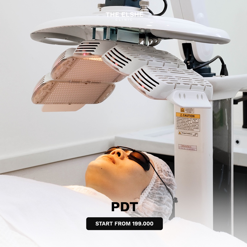 PDT Treatment The Elshe Clinic