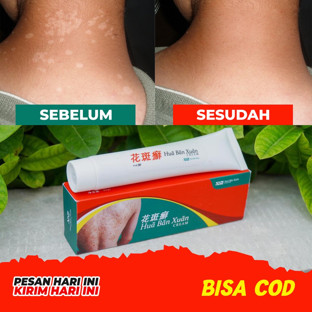 BELI 2 PCS SALEP HUA BAN XUAN - SALEP HERBAL CINA HILANGKAN PANU JAMUR KUTU AIR KURAP DAN LAINNYA