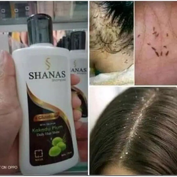Shampo Ketombe / Shampo Ketombe Dan Rontok / Shampo Ketombe Berkerak / Shampo Ketombe Dan Rambut Ron